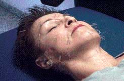 Facial Acupuncture 