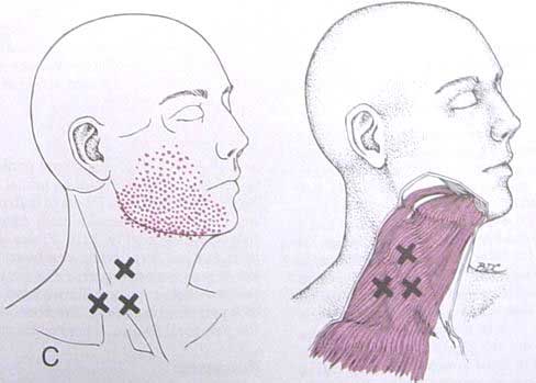 Trigger points on the neck