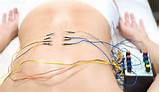 Electro Acupuncture in the lower back